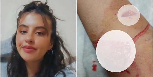 Şanlıurfa'da genç kız köpek saldırısıyla yaralandı