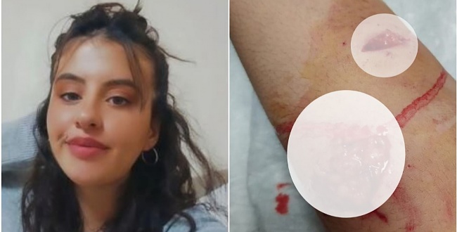 Şanlıurfa'da genç kız köpek saldırısıyla yaralandı