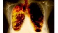 '17 Kasım Dünya Akciğer Kanseri Günü'