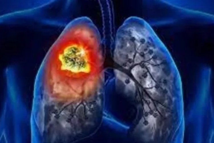 AKCİĞER KANSERİ ERKEN DÖNEMDE BELİRTİ VERMİYOR: GEÇMEYEN ÖKSÜRÜĞÜ HAFİFE ALMAYIN!